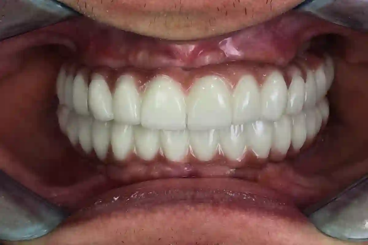 دندانپزشکی دکتر علی ضیائی متخصص ایمپلنت