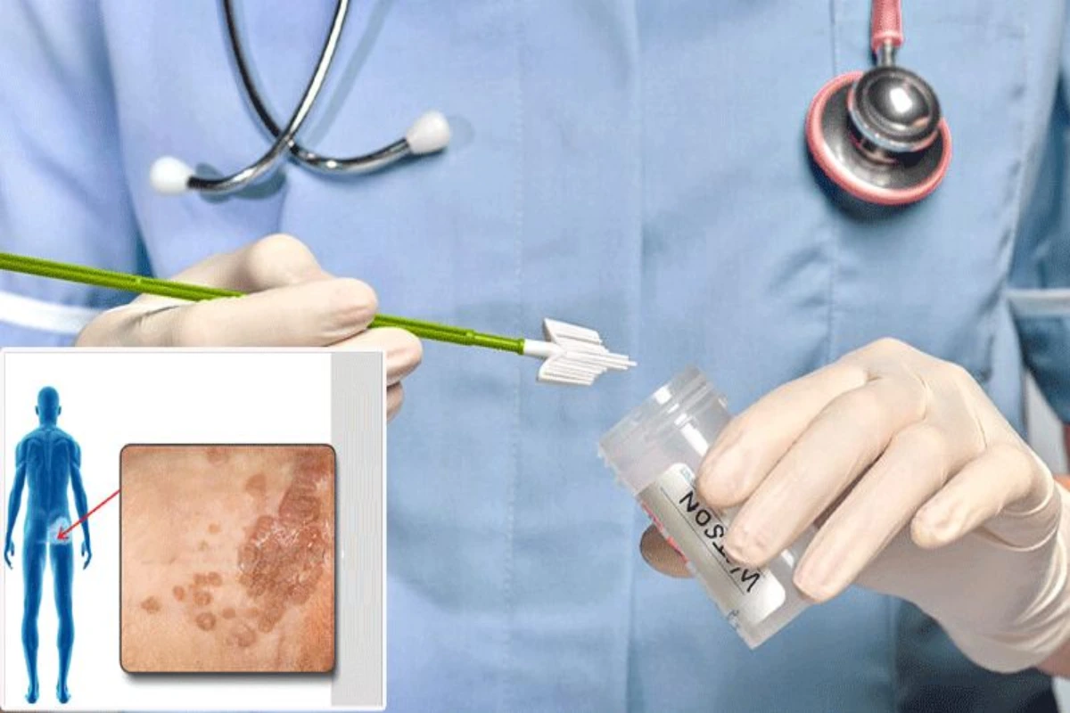 هزینه درمان زگیل تناسلی و روش درمان